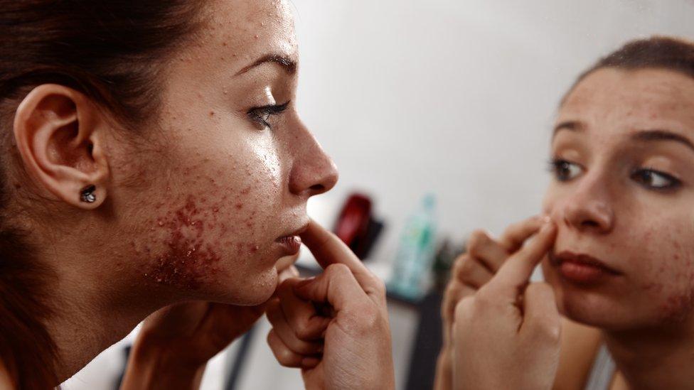 Girl with acne