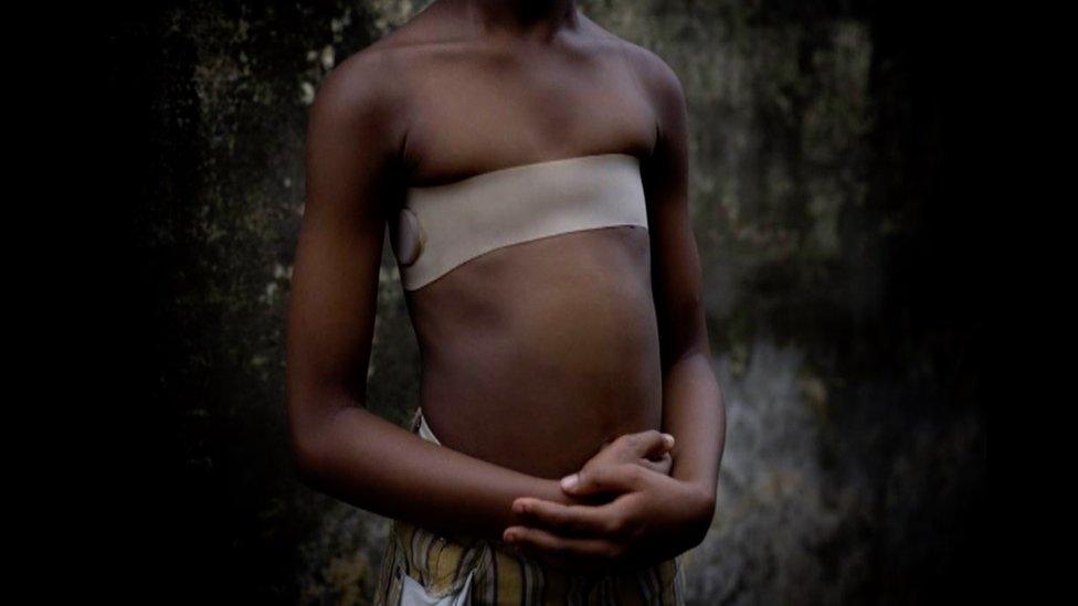 A girl with strap around her chest following breast ironing