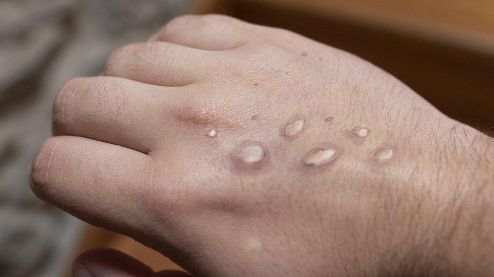 Monkeypox rash