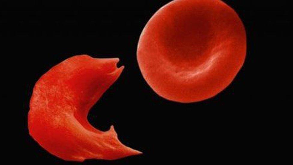 Sickle cell