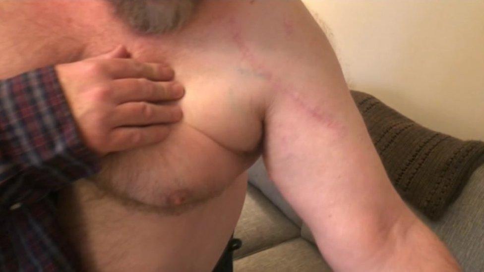 Graham Budd's scar on his shoulder from the knife attack