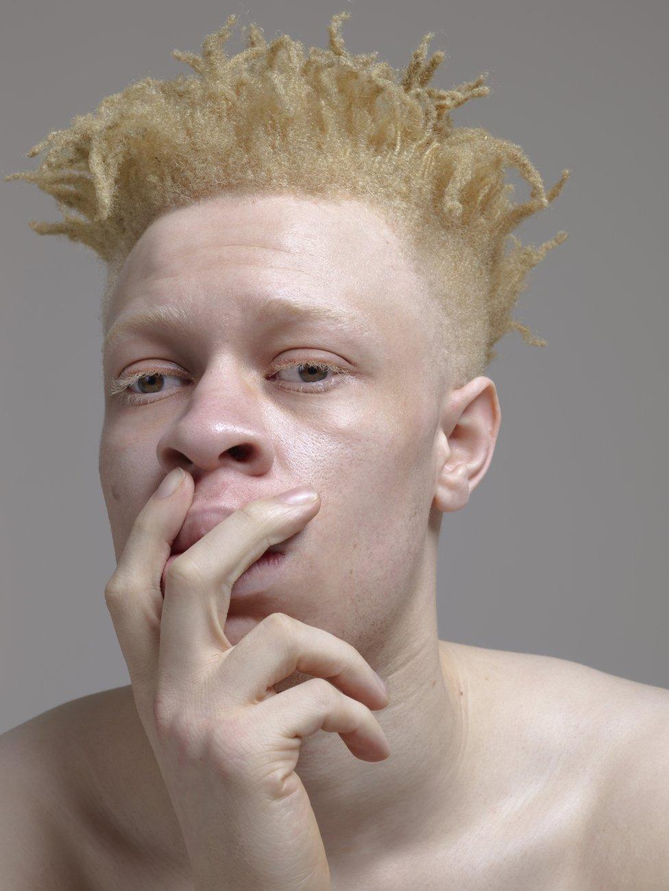 A portrait of a man with albinism