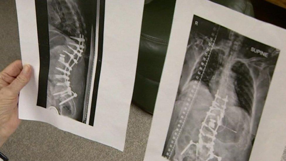 Judith Mills holding X-rays of her spine