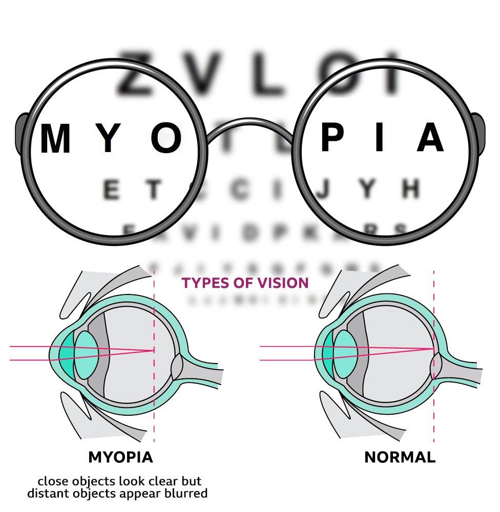 Myopia