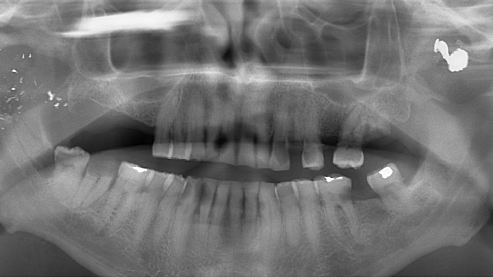 X-ray showing a bullet lodged in Ray Weatherall's cheekbone