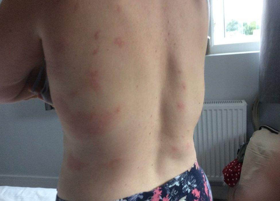 Wasp stings