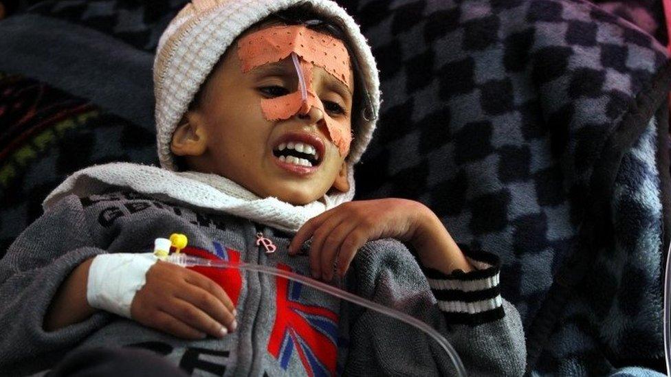 A malnourished Yemeni child receiving treatment in Sanaa, 24 November 2017