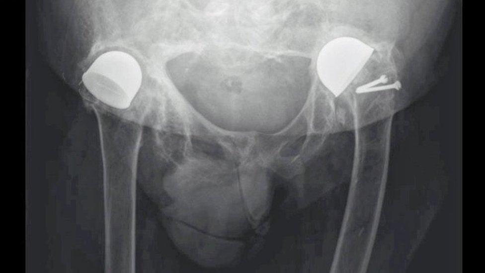 X-ray of Norman Sharp's hips