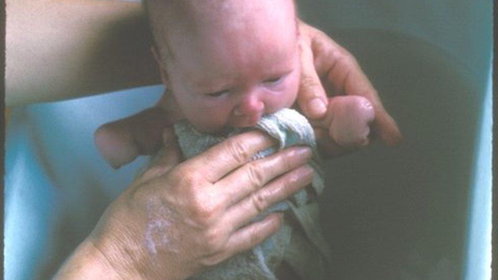 Lisa McManus as a baby in the bath with shortened arms