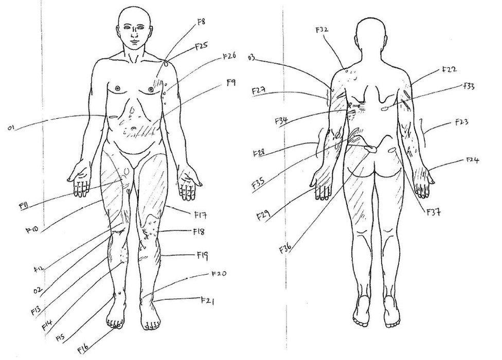 Body map showing Tara Newbold's body injuries