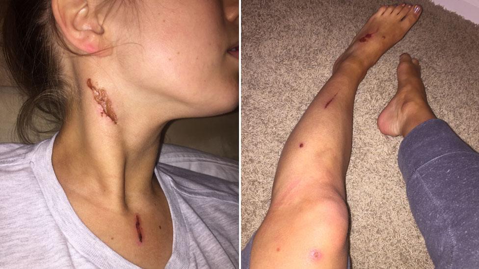 Injuries on Lauren Trent's neck and leg