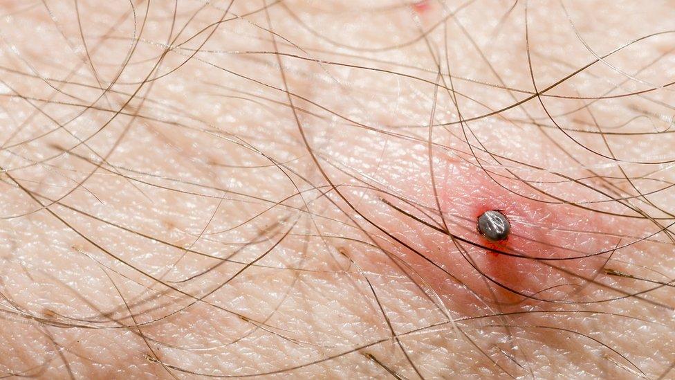 A tick on a man's skin