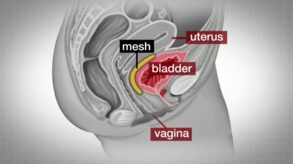 diagram of vaginal mesh implant