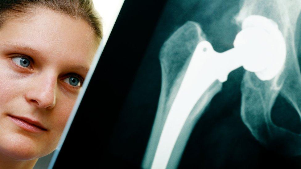 woman studying x-ray of hip replacement