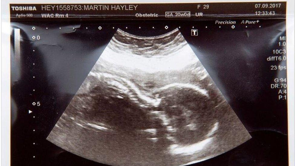 Hayley Martin's scan picture