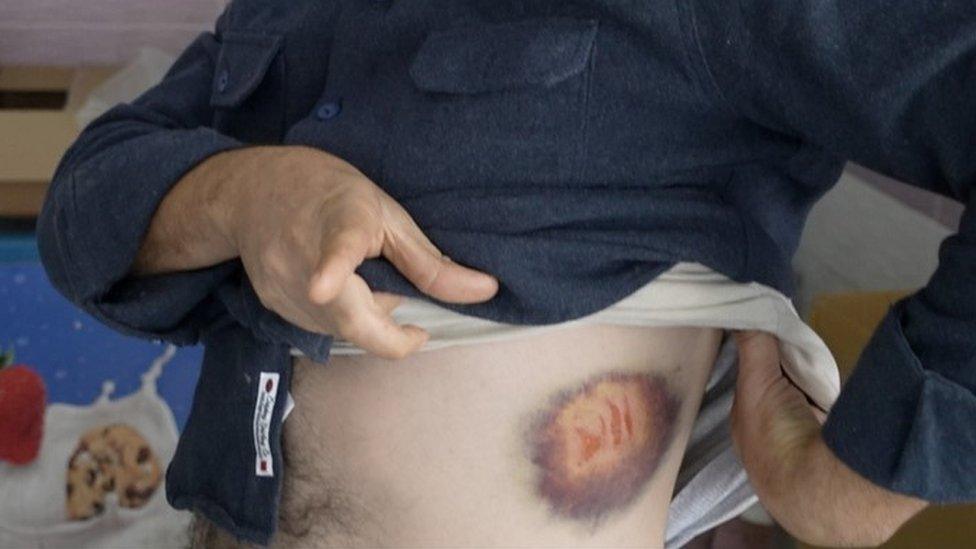 Bahaa Odeh shows his rubber bullet injury