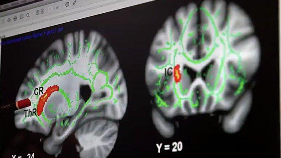 Detail of brain scanned by Dr James Cantor