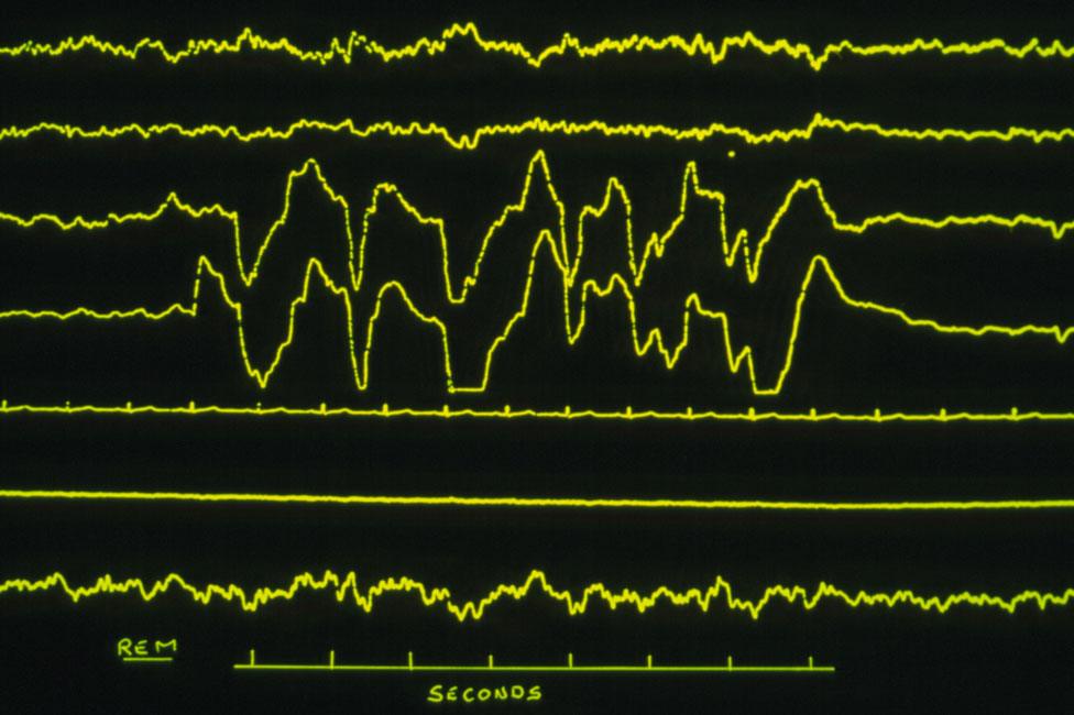 EEG showing patient in REM sleep