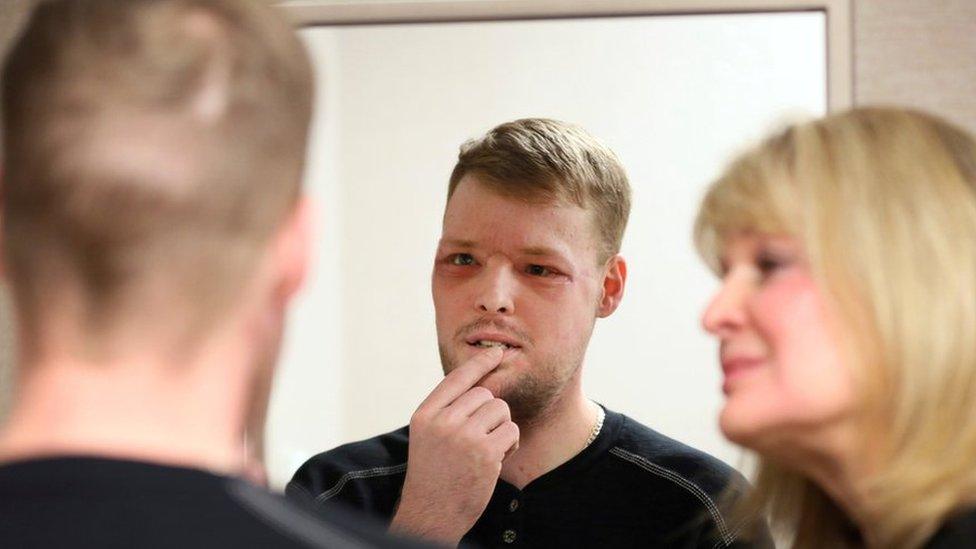 In this Jan. 24, 2017, photo, face transplant recipient Andy Sandness looks in a mirror during an appointment with physical therapist Helga Smars, right, at Mayo Clinic in Rochester, Minn