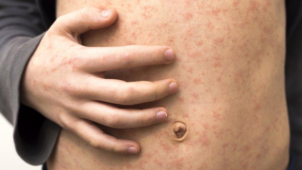 The stomach and hand of a child with measles