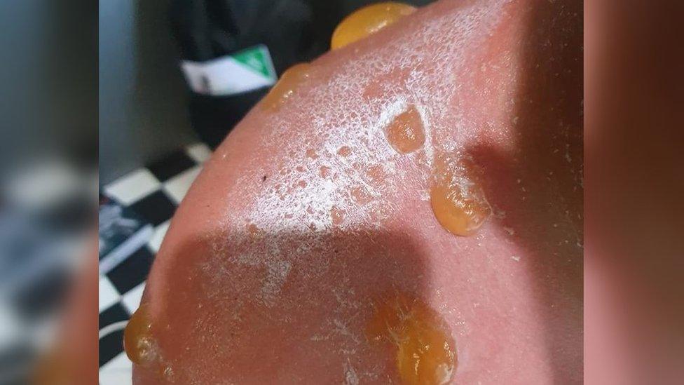 Blisters and a severe burn on Owi's shoulder