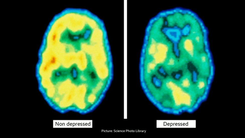 A brain scan showing how a depressed brain has less electrical stimulation than a brain without depression