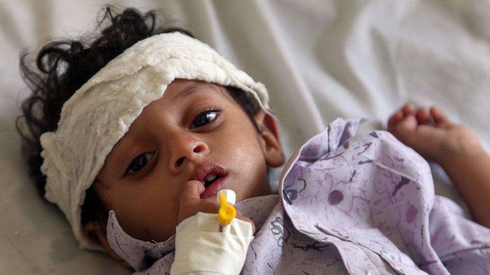 A Yemeni child lies on a bed after receiving treatment for malnutrition at a treatment centre in a hospital in the third city of Taez in the country's southwest on November 21, 2018