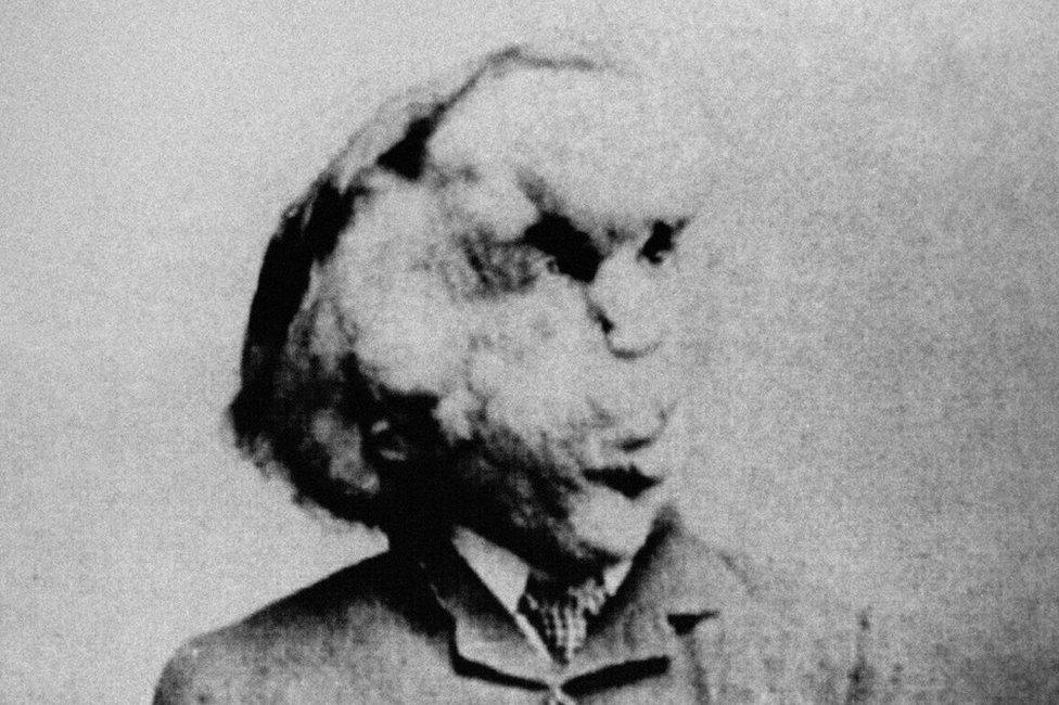 Joseph Carey Merrick, known as the Elephant Man, is shown in a photo from the Radiological Society of North America