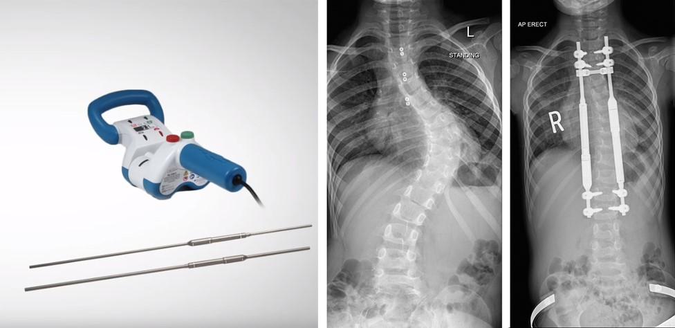 Magec rods and megnetic controller with X-rays of devices implanted