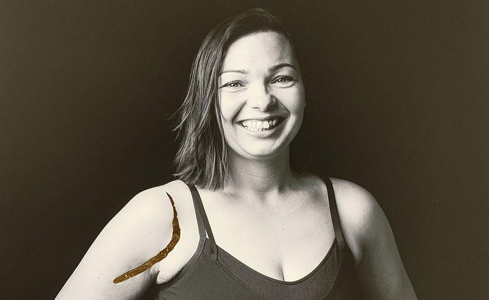 A black and white image of a female patient with a scar on her shoulder filled in with gold leaf