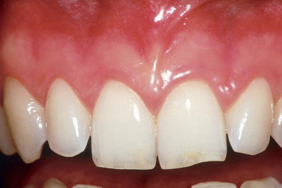 Patient with gingivitis