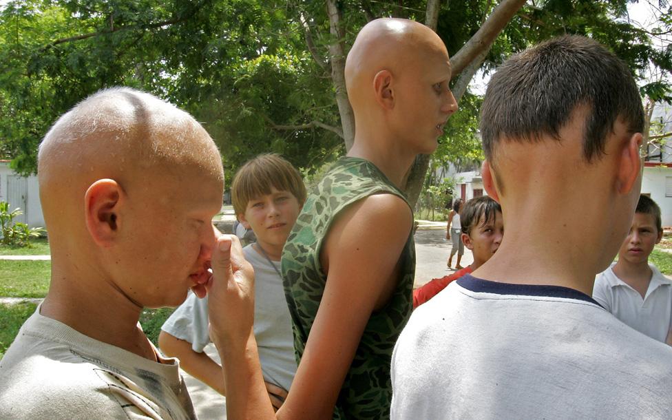 Ukrainian children, who are patients of the Hospital de Tarara, in Tarara, Cuba