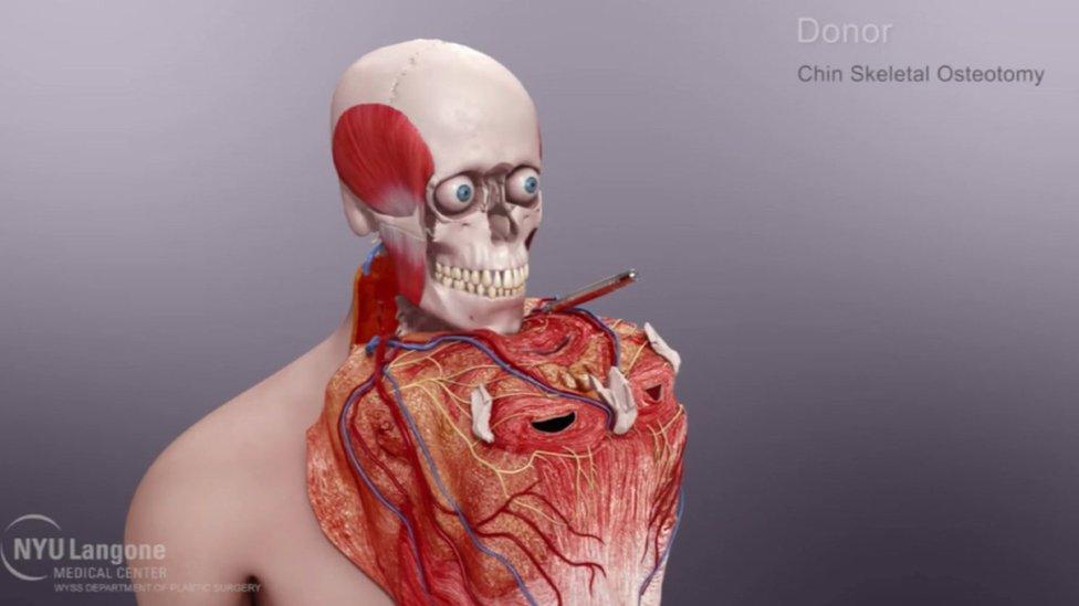 Graphic of how the donor tissue was prepared