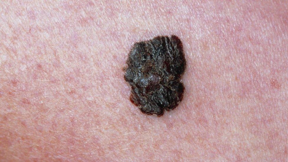 Malignant melanoma