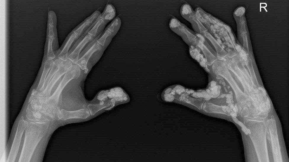 Calcinosis in the hands