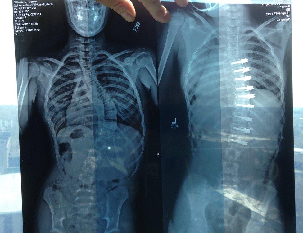 The x-rays show a spine before (left) and after (right) the operation