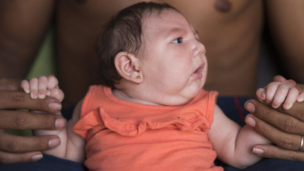 Baby with mircocephaly, linked to Zika virus