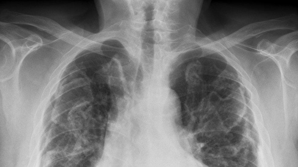 Chest X-ray