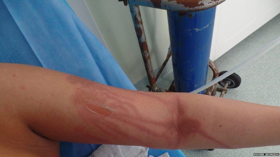 Photo showing burn to Phoebe's arm