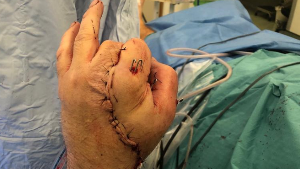 Anthony's hand after surgery