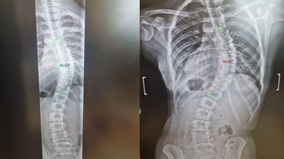 The X-ray on the left was taken in June last year, while the one on the right was taken in September and shows the curvature of Scarlett’s spine is getting worse