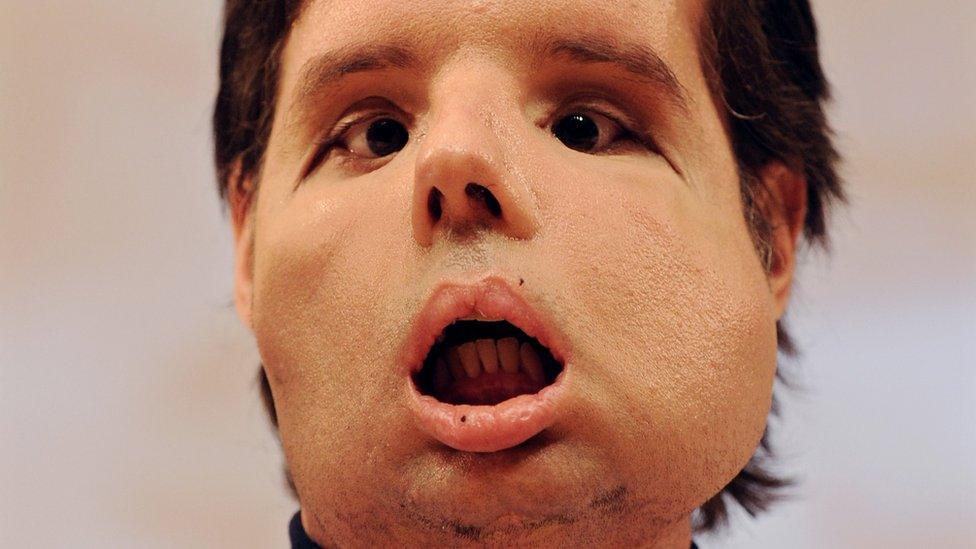 Oscar, the world's first full face transplant patient