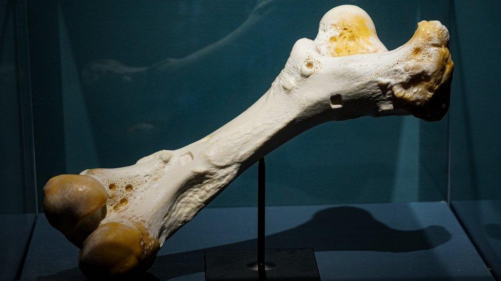 'Bone' exhibit at Thackray Medical Museum