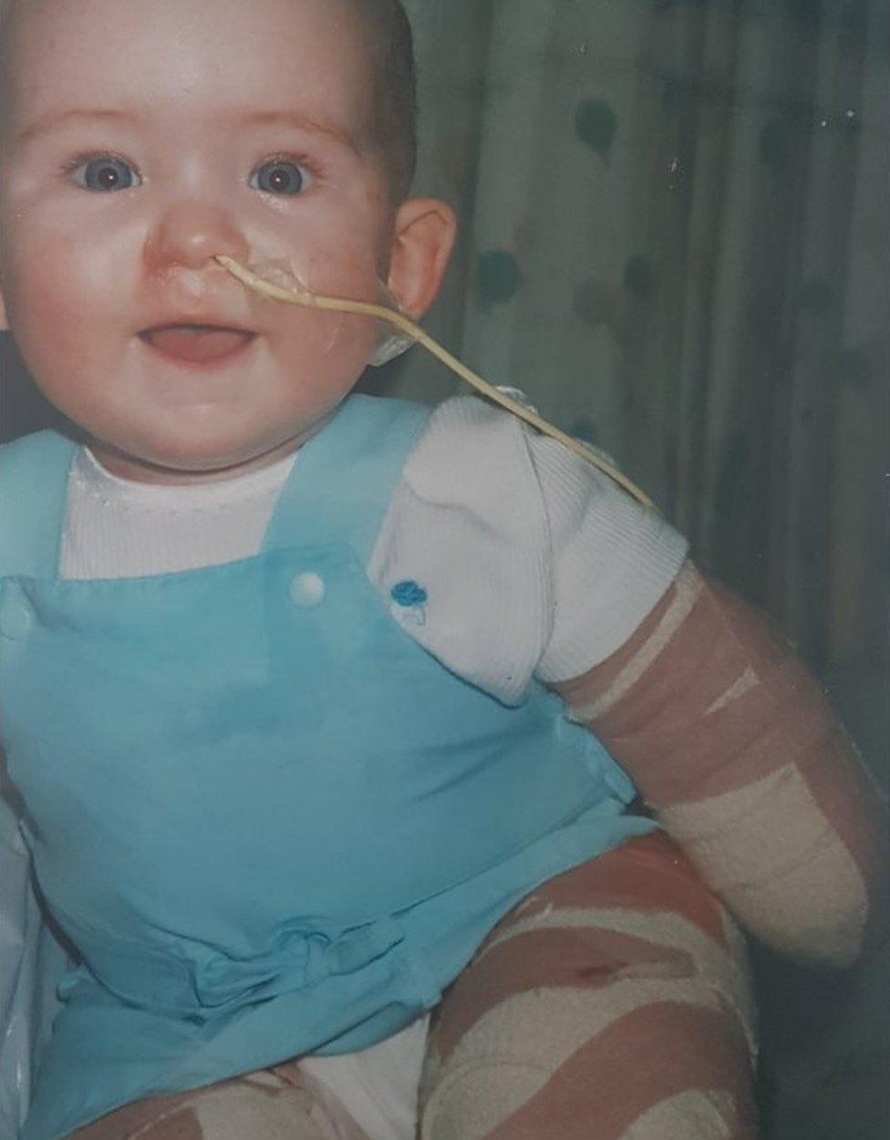 Taylor McTaggart when she was baby just after the operations