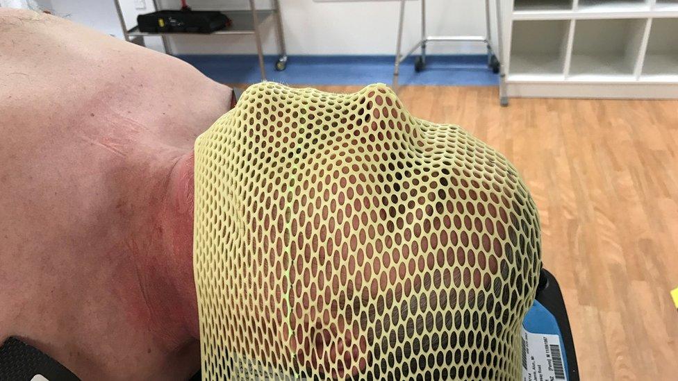 Jamie with mesh over his face in hospital