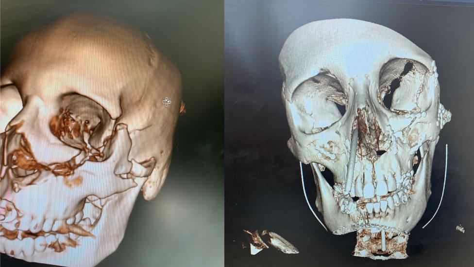 CT scan of Shannon's skull