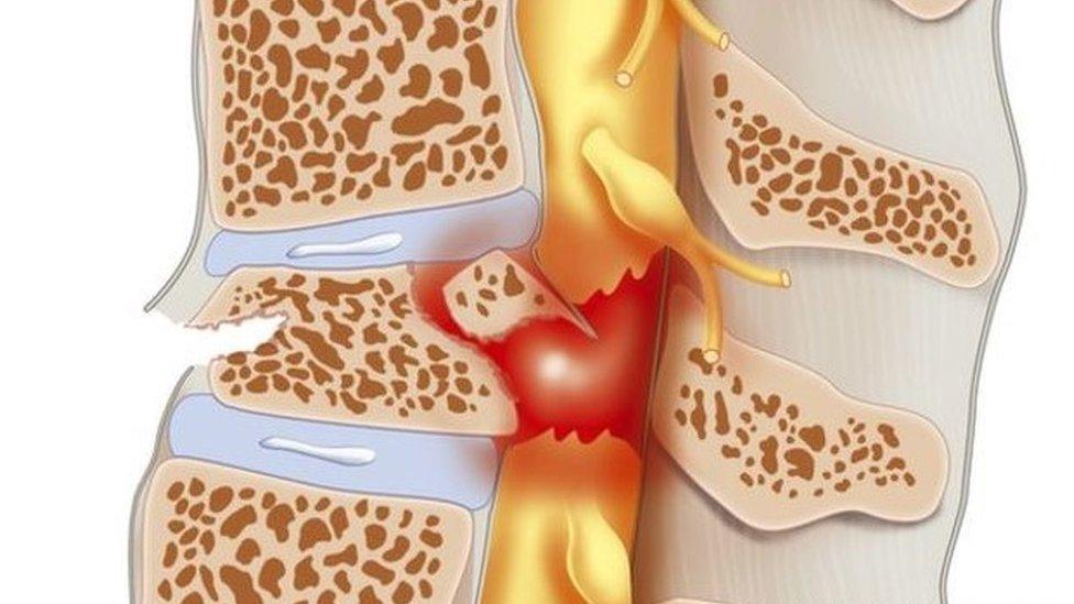 Spinal cord injury