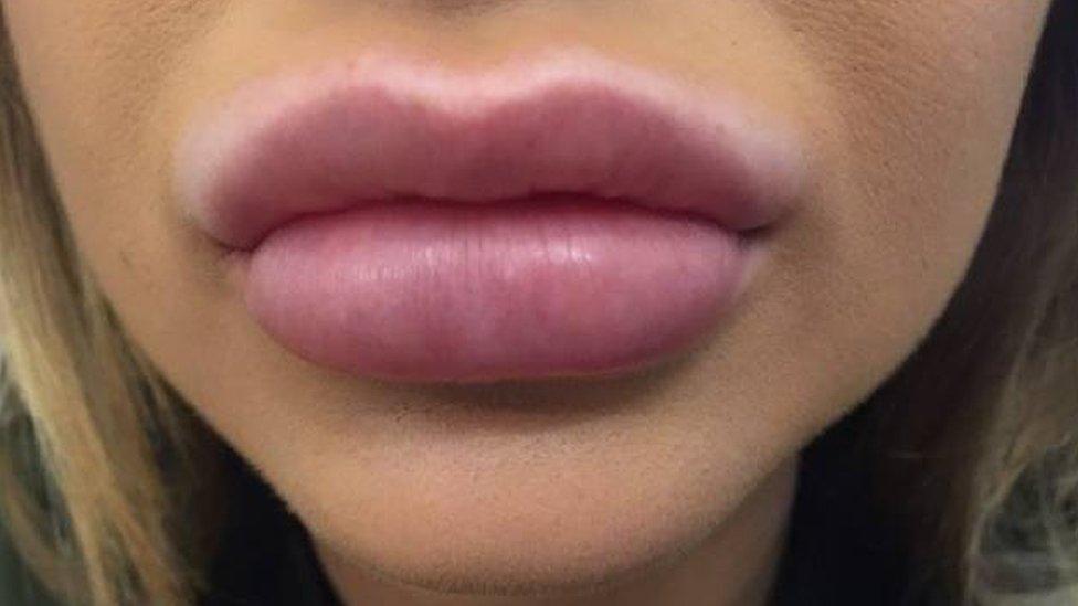 woman with overfilled lips