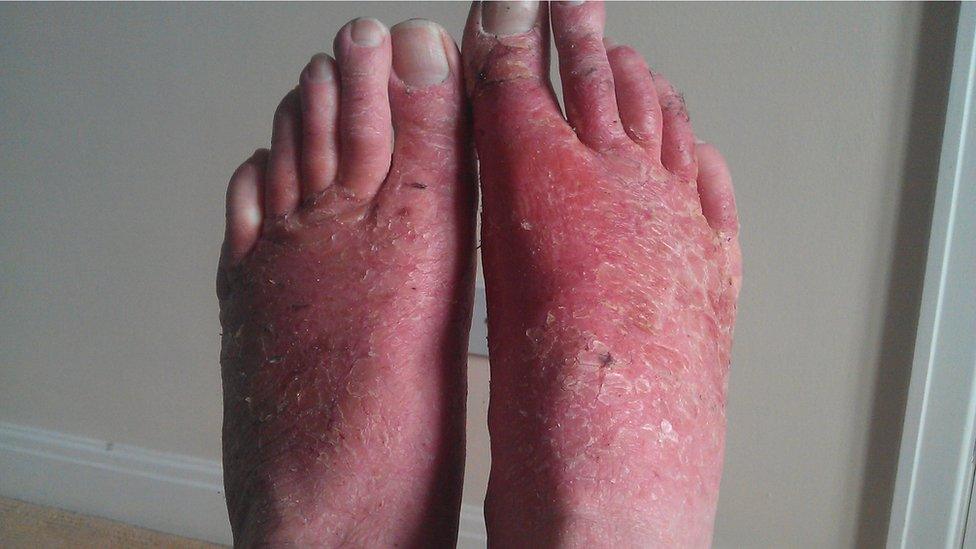 Foot with eczema