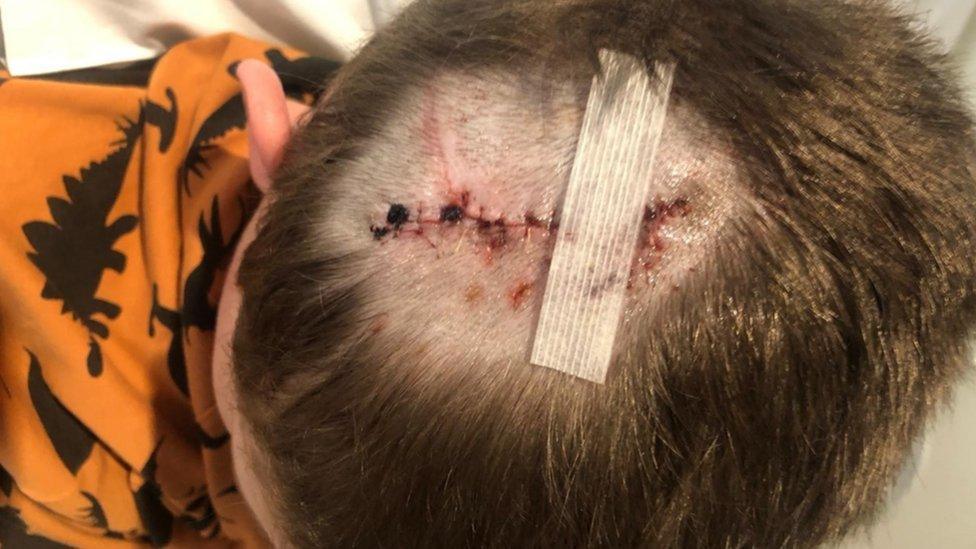 Stitches on a dog bite on a child's head